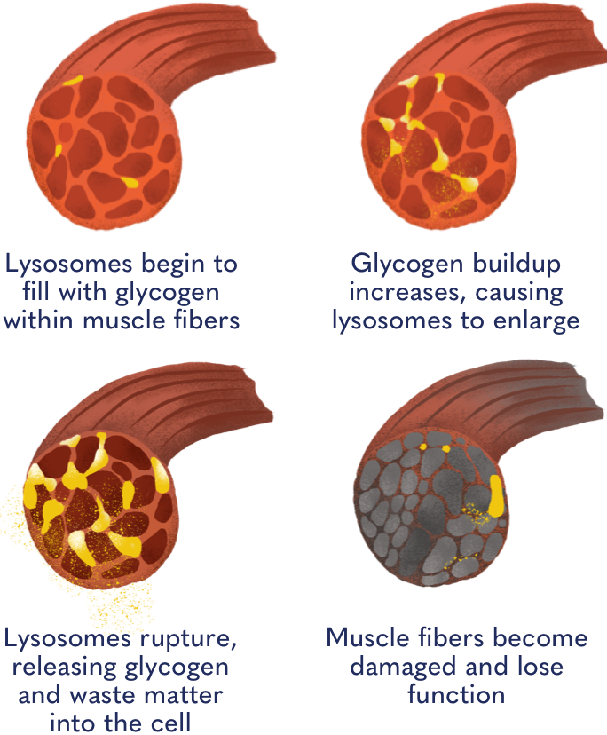 Glycogen damage
