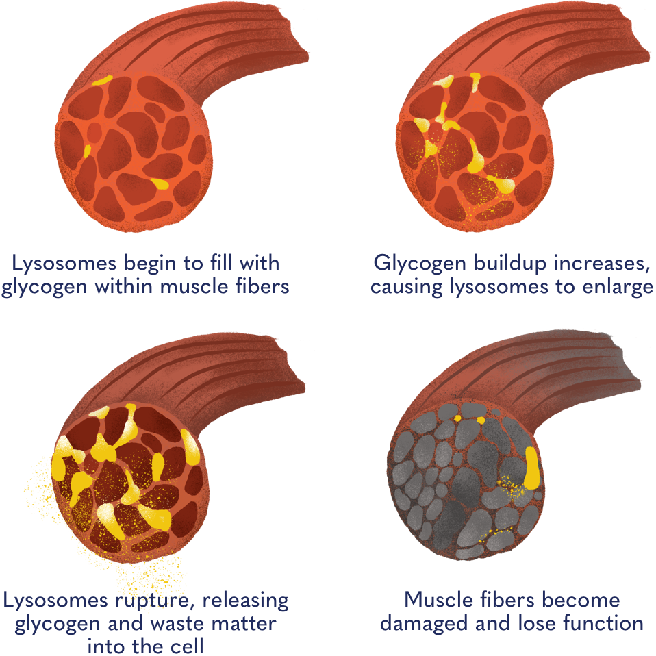 Glycogen damage